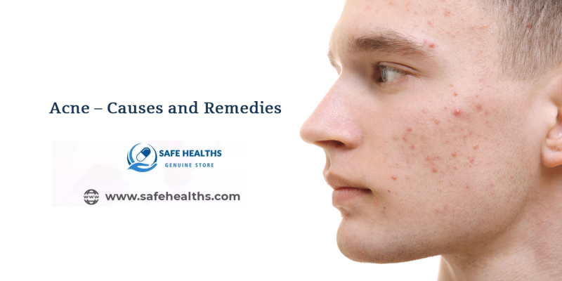 Acne - Causes and Remedies