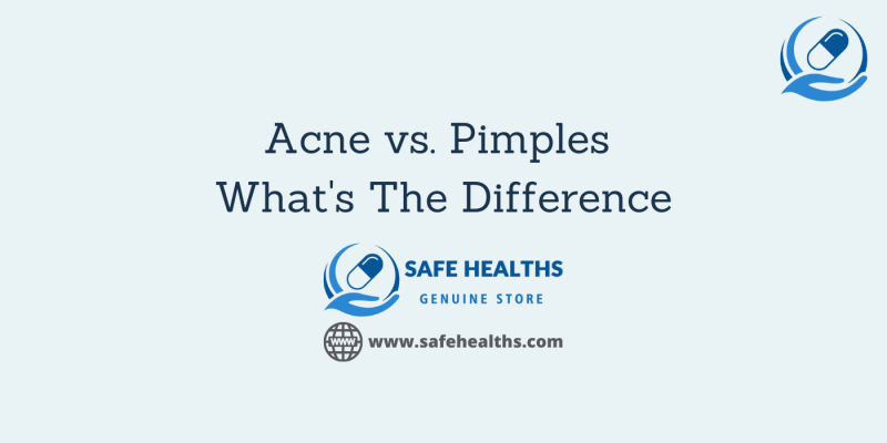 Acne vs Pimples Whats The Difference